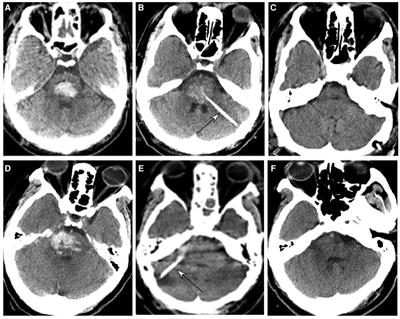 Effects of stereotactic aspiration on brainstem hemorrhage in a case series